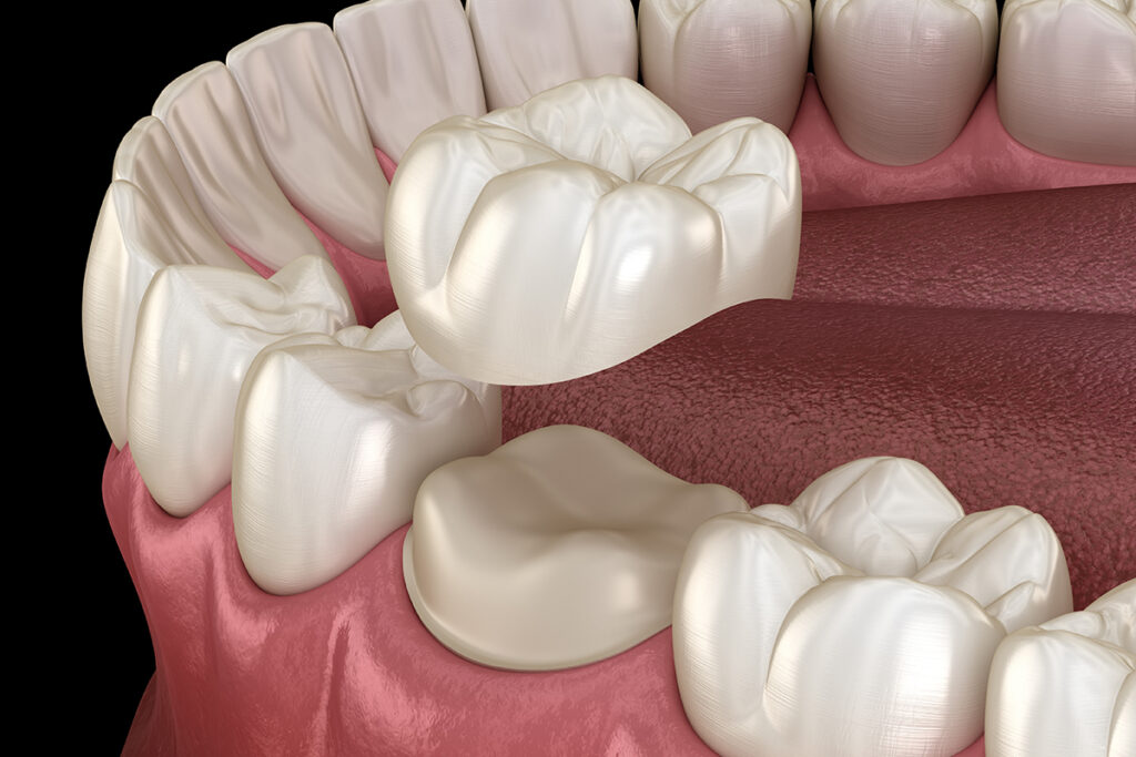 How Invisalign works step by step