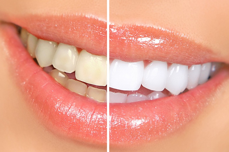 Invisalign treatment for straightening front teeth