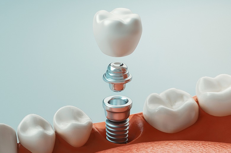 Patient smiling with Invisalign aligners in place
