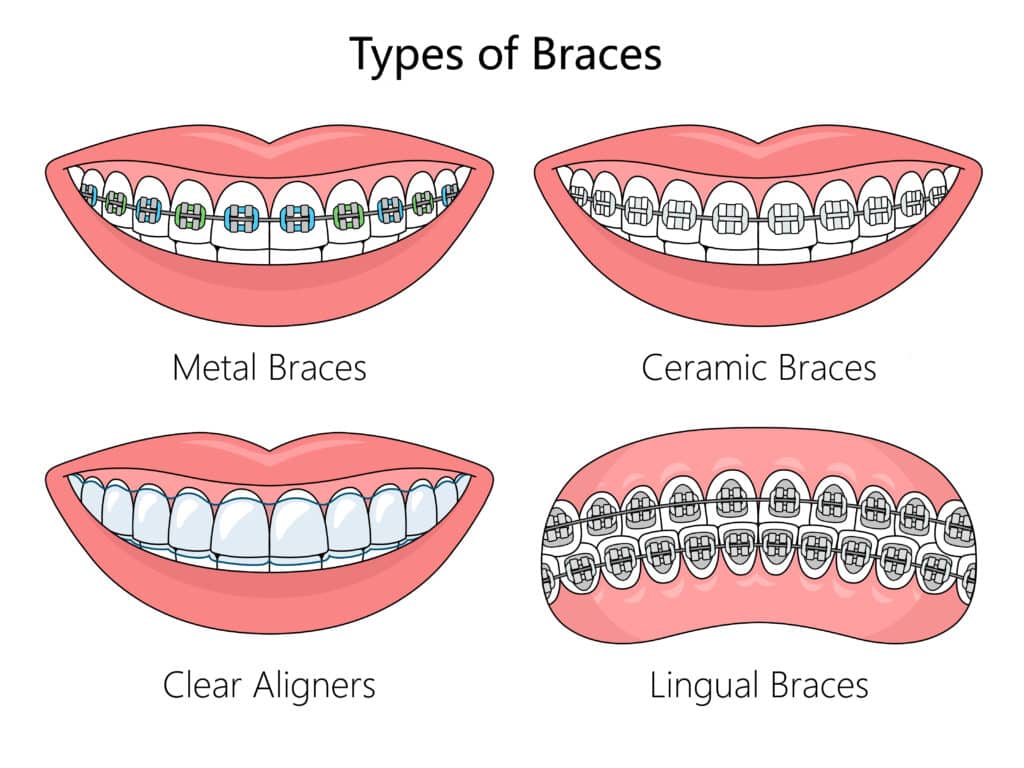 four types of dental braces
