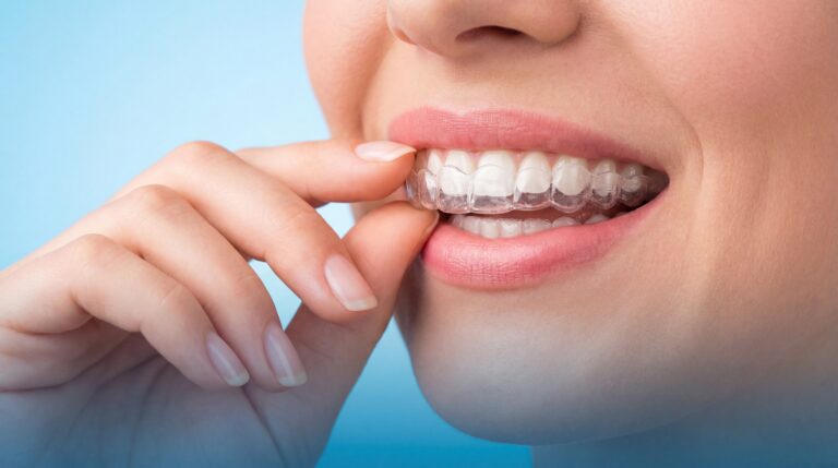 How Quickly Do Teeth Move with Invisalign?