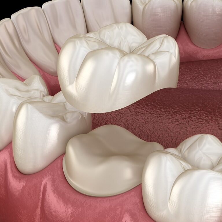 How Invisalign works step by step