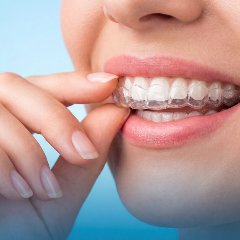 How Quickly Do Teeth Move with Invisalign?