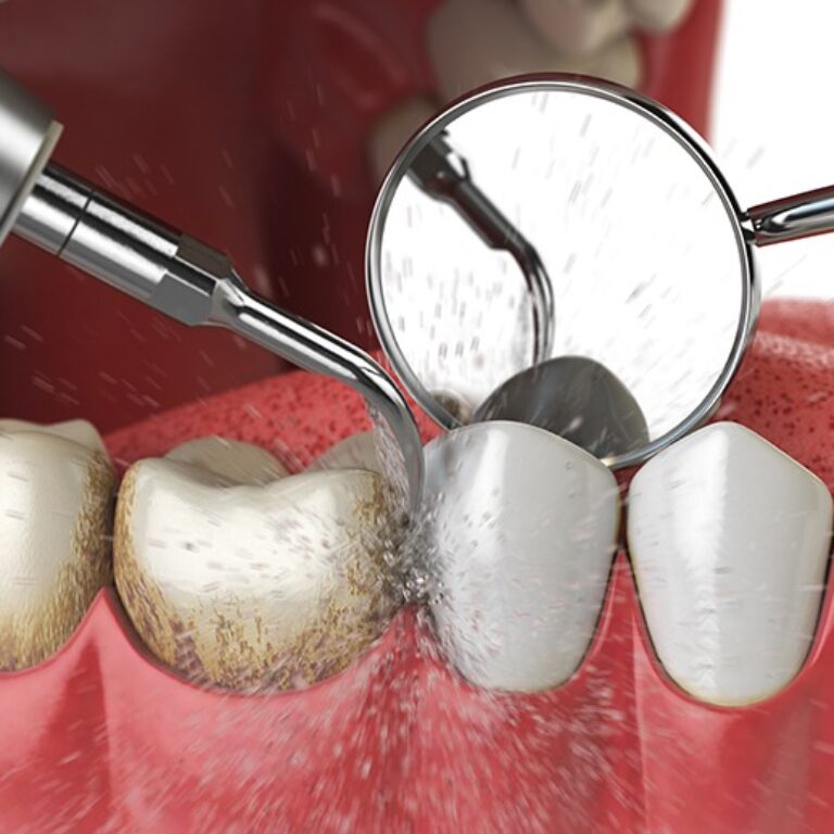 Murphy Dental Group advanced Invisalign technology