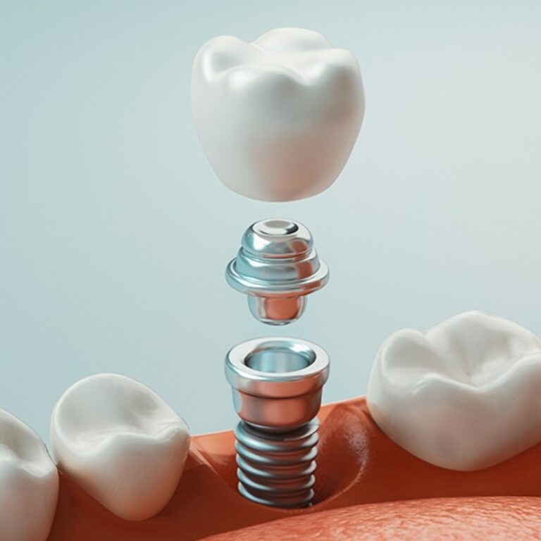 Patient smiling with Invisalign aligners in place