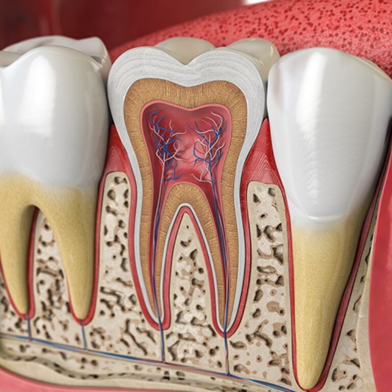Invisalign for improving dental alignment